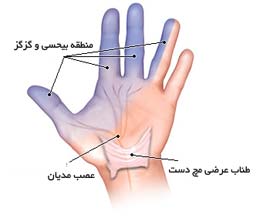 محل بی حسی در سی تی اس