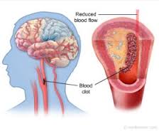 انواع سکته مغزی
