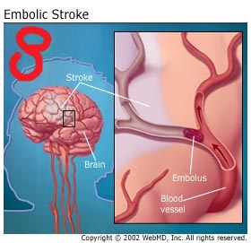 سکته از نوع آمبولیک